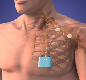 Peripheral nerve stimulation treatment for chronic nerve pain