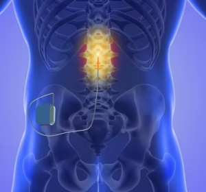 Medical illustration highlighting spinal pain and nerve stimulation treatment