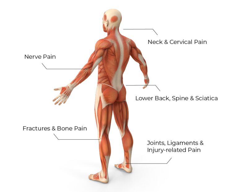 Body pain diagram showing common back, neck, shoulder, and nerve pain areas